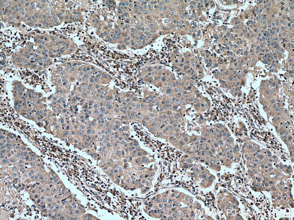 Immunohistochemistry (IHC) staining of human breast cancer tissue using MMP9 (N-terminal) Polyclonal antibody (10375-2-AP)