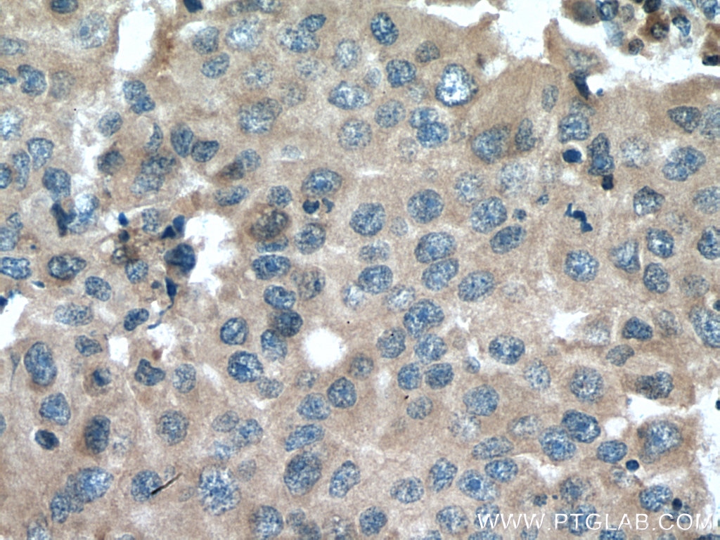 Immunohistochemistry (IHC) staining of human breast cancer tissue using MMP9 (N-terminal) Polyclonal antibody (10375-2-AP)