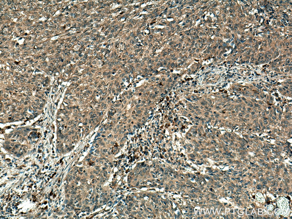 Immunohistochemistry (IHC) staining of human cervical cancer tissue using MMP9 (N-terminal) Polyclonal antibody (10375-2-AP)