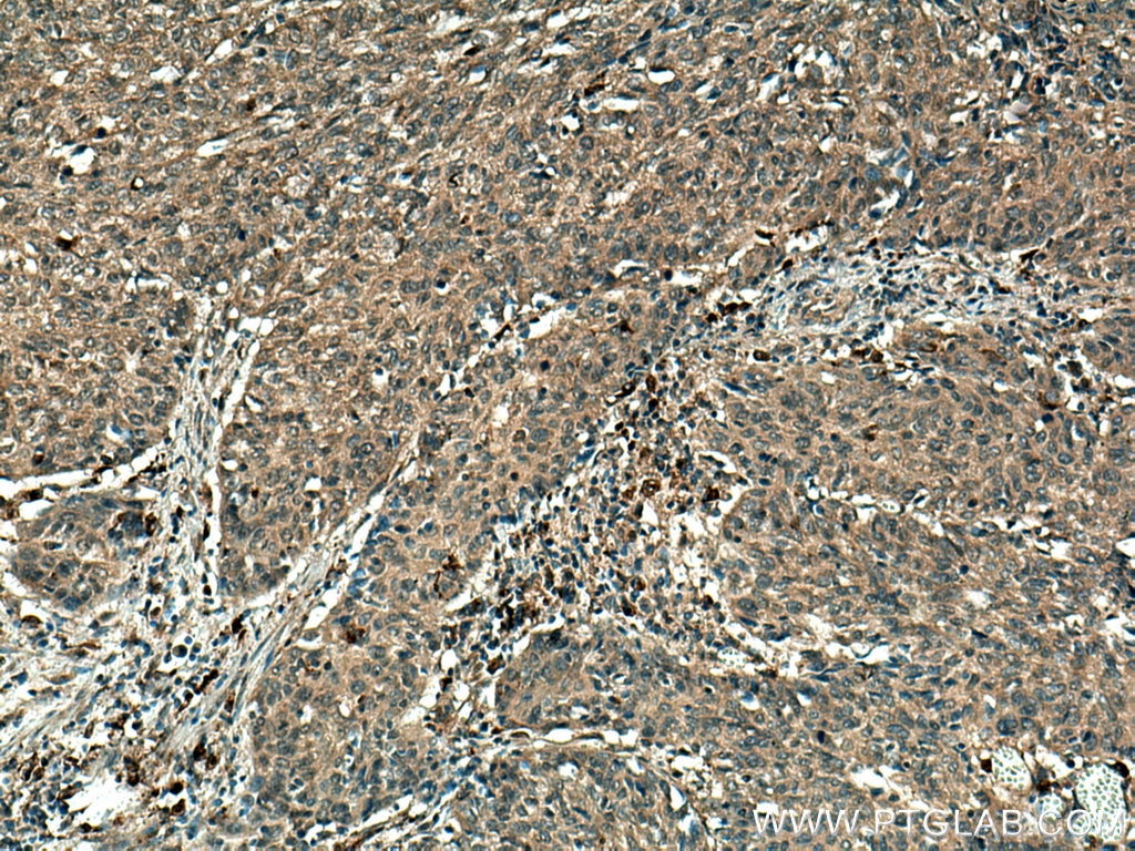 IHC staining of human cervical cancer using 10375-2-AP