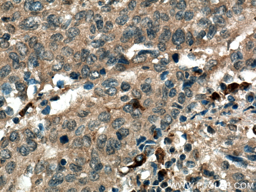 Immunohistochemistry (IHC) staining of human cervical cancer tissue using MMP9 (N-terminal) Polyclonal antibody (10375-2-AP)