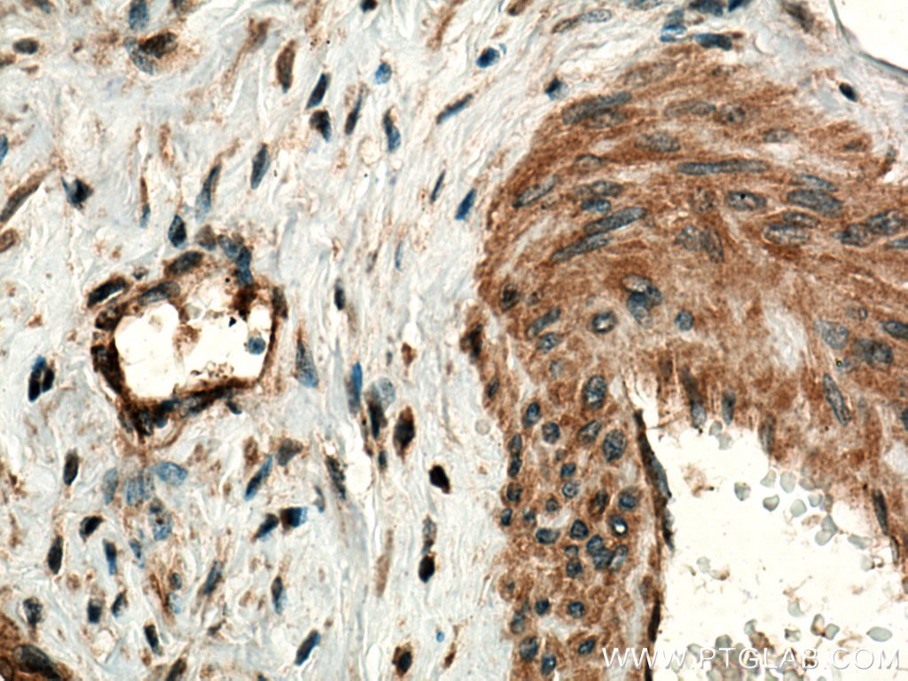 Immunohistochemistry (IHC) staining of human cervical cancer tissue using MMP9 (N-terminal) Polyclonal antibody (10375-2-AP)