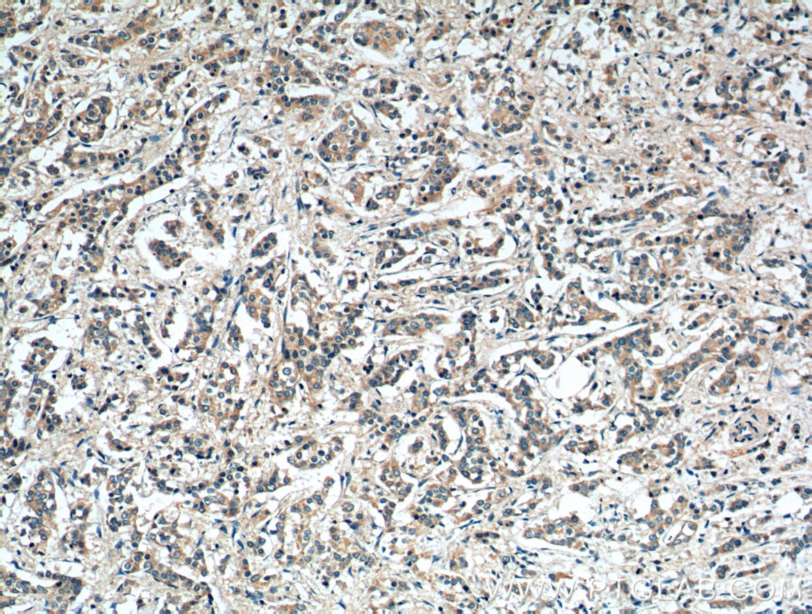 Immunohistochemistry (IHC) staining of human breast cancer tissue using MMP9 (N-terminal) Polyclonal antibody (10375-2-AP)
