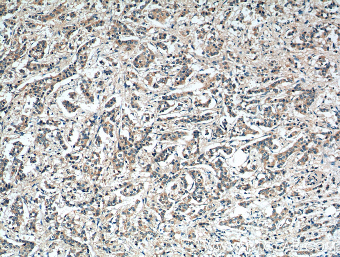 IHC staining of human breast cancer using 10375-2-AP