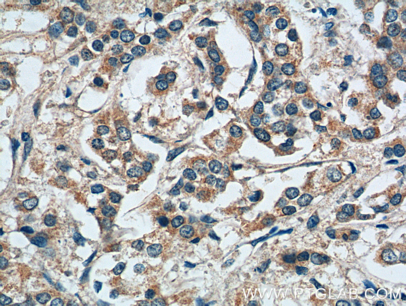 Immunohistochemistry (IHC) staining of human breast cancer tissue using MMP9 (N-terminal) Polyclonal antibody (10375-2-AP)