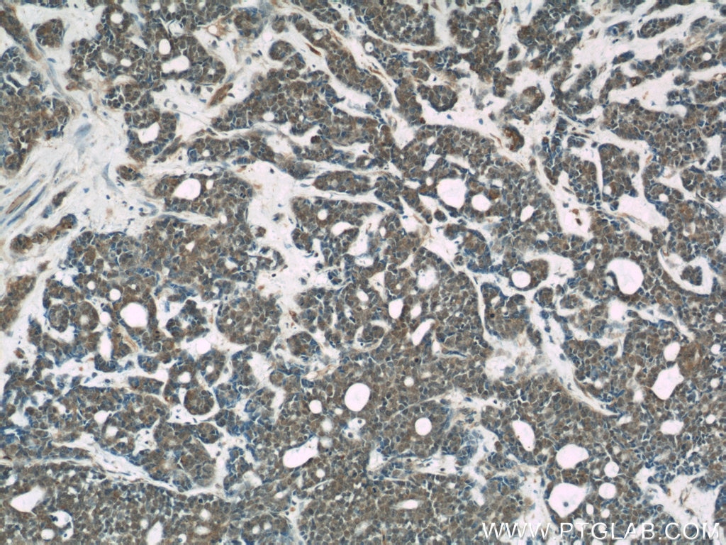 Immunohistochemistry (IHC) staining of human cervical cancer tissue using MMS19 Monoclonal antibody (66049-1-Ig)