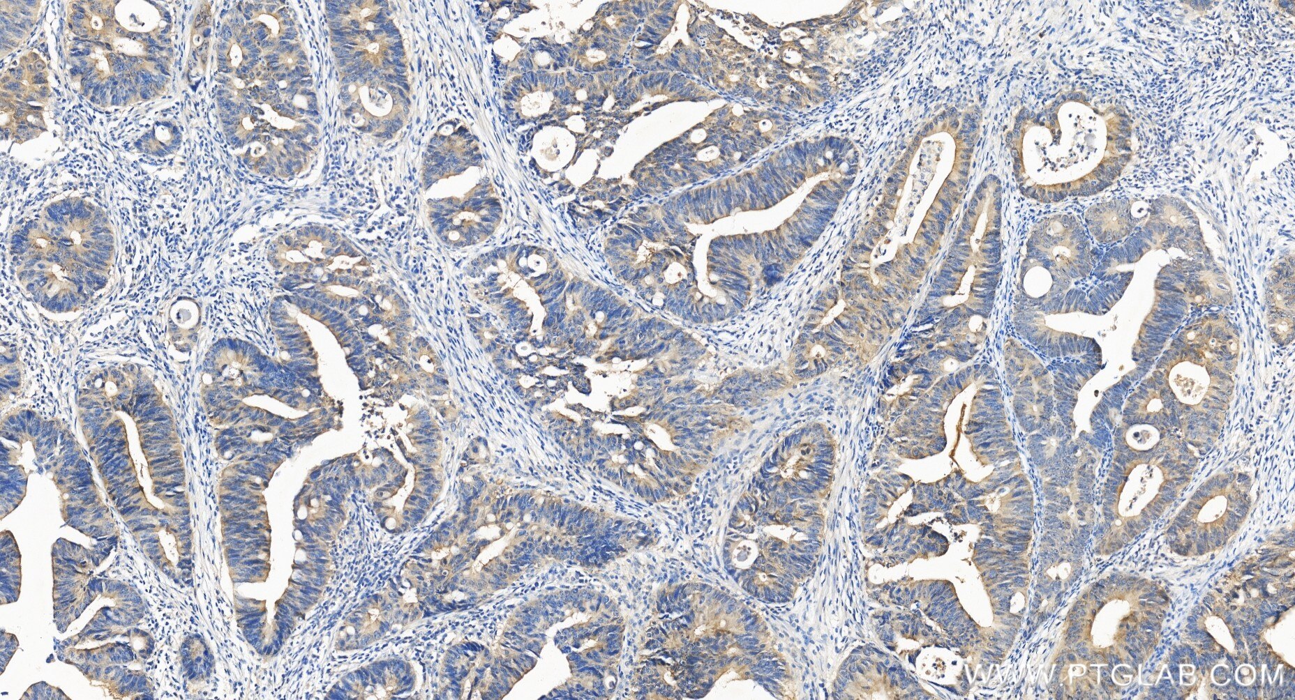 Immunohistochemistry (IHC) staining of human colon cancer tissue using MMS2 Recombinant monoclonal antibody (86551-3-RR)