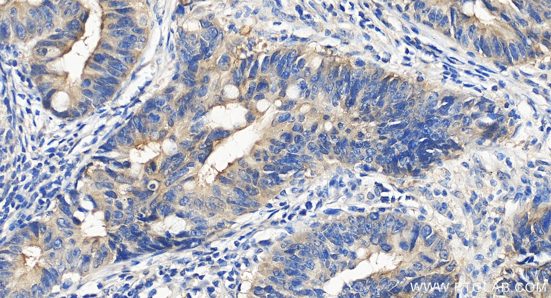 Immunohistochemistry (IHC) staining of human colon cancer tissue using MMS2 Recombinant monoclonal antibody (86551-3-RR)