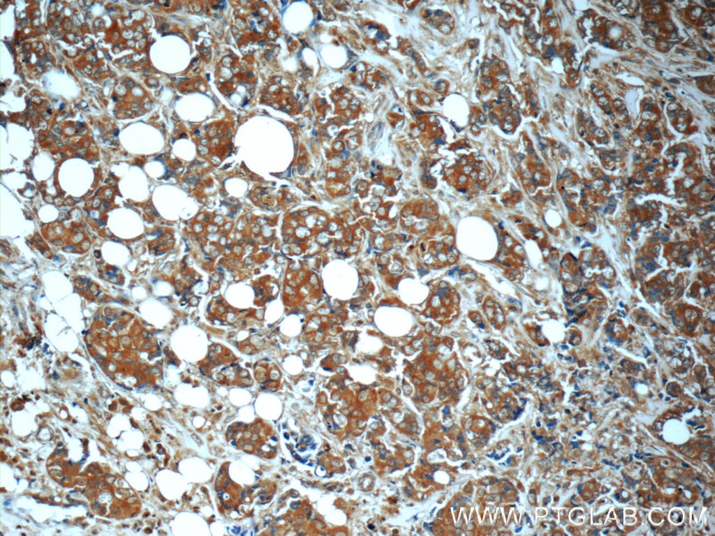 Immunohistochemistry (IHC) staining of human breast cancer tissue using MN1 Polyclonal antibody (24697-1-AP)