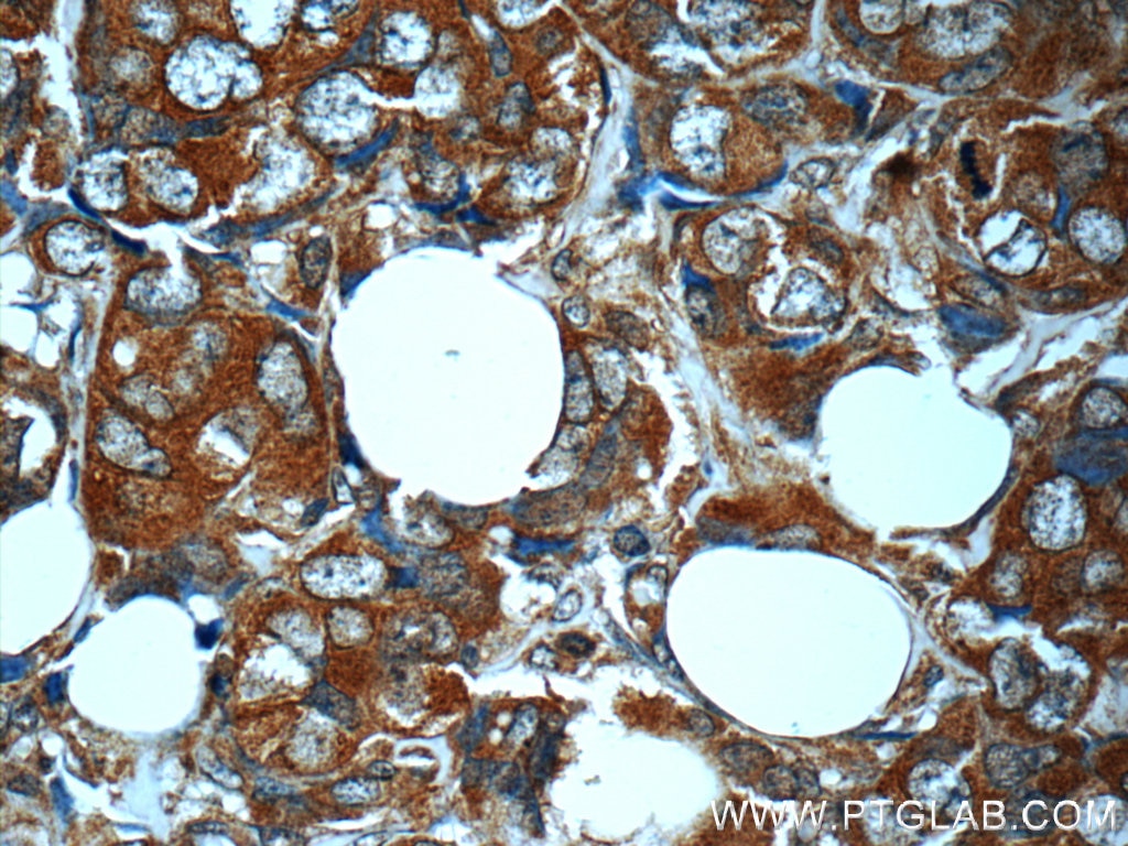 Immunohistochemistry (IHC) staining of human breast cancer tissue using MN1 Polyclonal antibody (24697-1-AP)