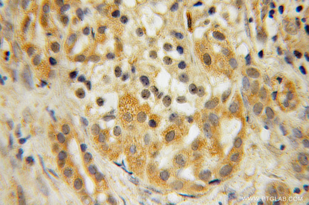 Immunohistochemistry (IHC) staining of human pancreas cancer tissue using MOBKL1A Polyclonal antibody (12790-1-AP)
