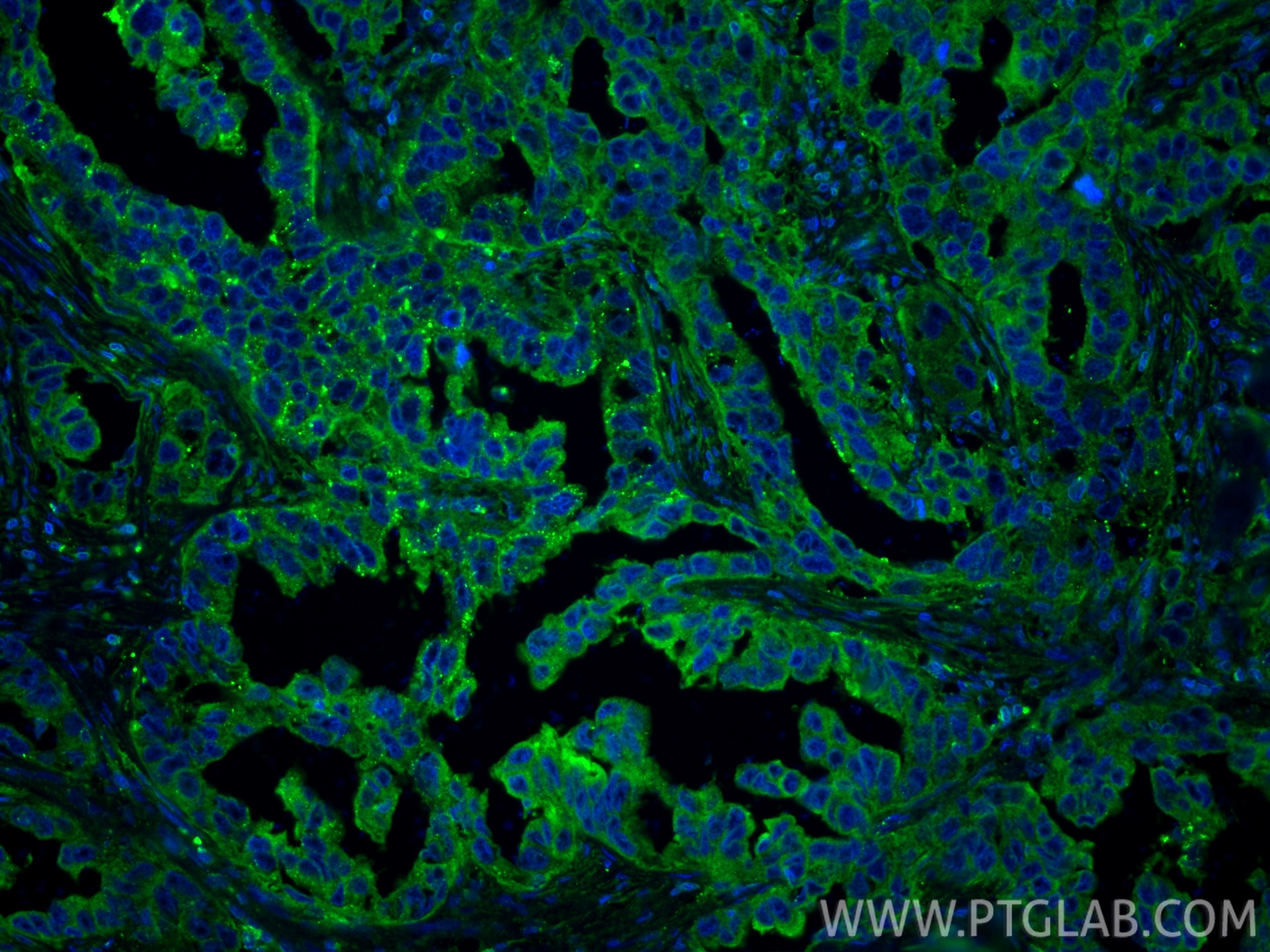 IF Staining of human colon cancer using 15886-1-AP Immunofluorescence (IF) / fluorescent staining of human colon cancer tissue using MOBKL3 Polyclonal antibody (15886-1-AP)
