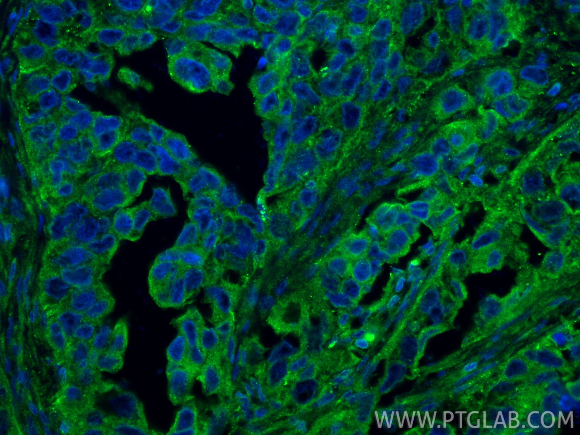 IF Staining of human colon cancer using 15886-1-AP Immunofluorescence (IF) / fluorescent staining of human colon cancer tissue using MOBKL3 Polyclonal antibody (15886-1-AP)