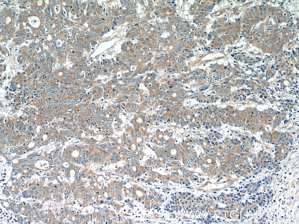 Immunohistochemistry (IHC) staining of human colon cancer tissue using MOBKL3 Polyclonal antibody (15886-1-AP)