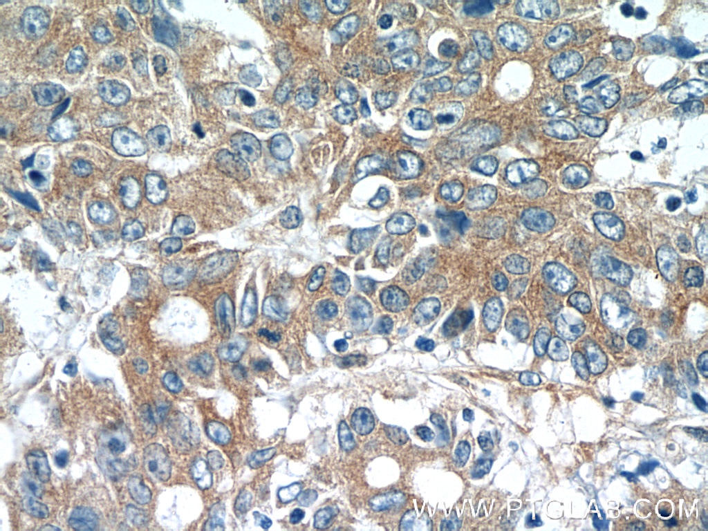 Immunohistochemistry (IHC) staining of human colon cancer tissue using MOBKL3 Polyclonal antibody (15886-1-AP)