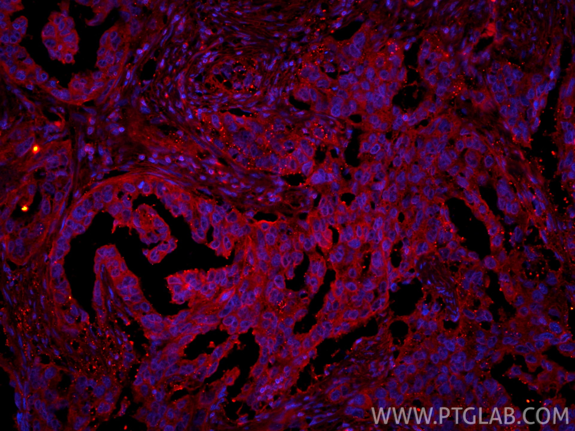 IF Staining of human colon cancer using CL594-15886 Immunofluorescence (IF) / fluorescent staining of human colon cancer tissue using CoraLite®594-conjugated MOBKL3 Polyclonal antibody (CL594-15886)