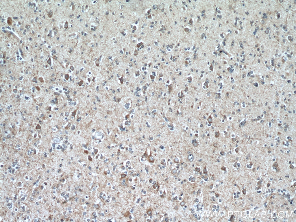 Immunohistochemistry (IHC) staining of human gliomas tissue using MOBP Polyclonal antibody (12472-1-AP)