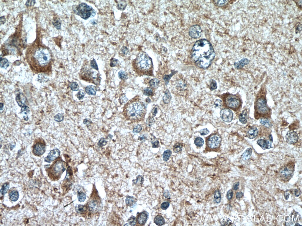 Immunohistochemistry (IHC) staining of human gliomas tissue using MOBP Polyclonal antibody (12472-1-AP)