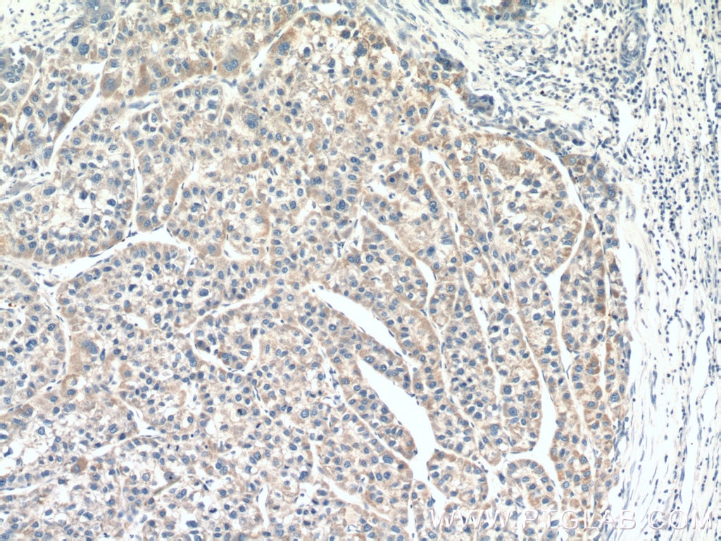 Immunohistochemistry (IHC) staining of human liver cancer tissue using MOCS3 Polyclonal antibody (27501-1-AP)