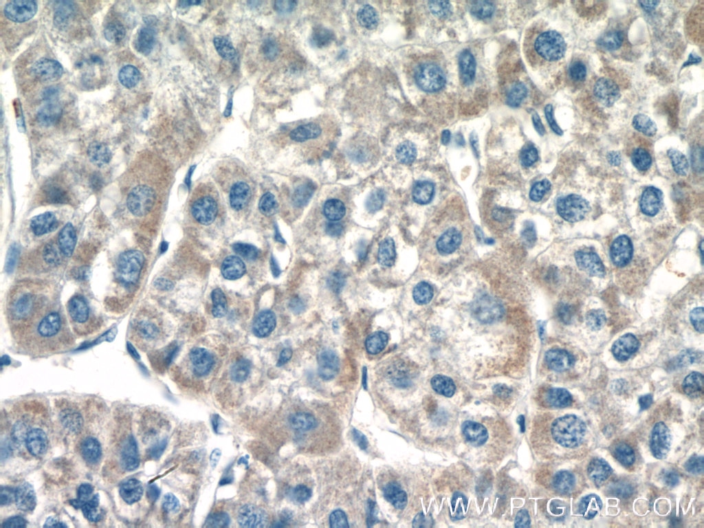 Immunohistochemistry (IHC) staining of human liver cancer tissue using MOCS3 Polyclonal antibody (27501-1-AP)