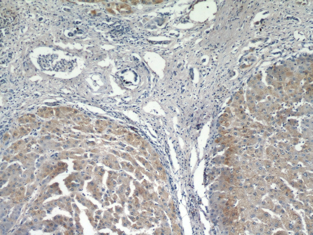 Immunohistochemistry (IHC) staining of human hepatocirrhosis tissue using MOGAT1 Polyclonal antibody (21573-1-AP)