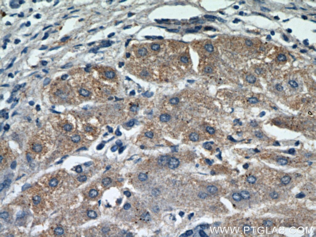 Immunohistochemistry (IHC) staining of human hepatocirrhosis tissue using MOGAT1 Polyclonal antibody (21573-1-AP)