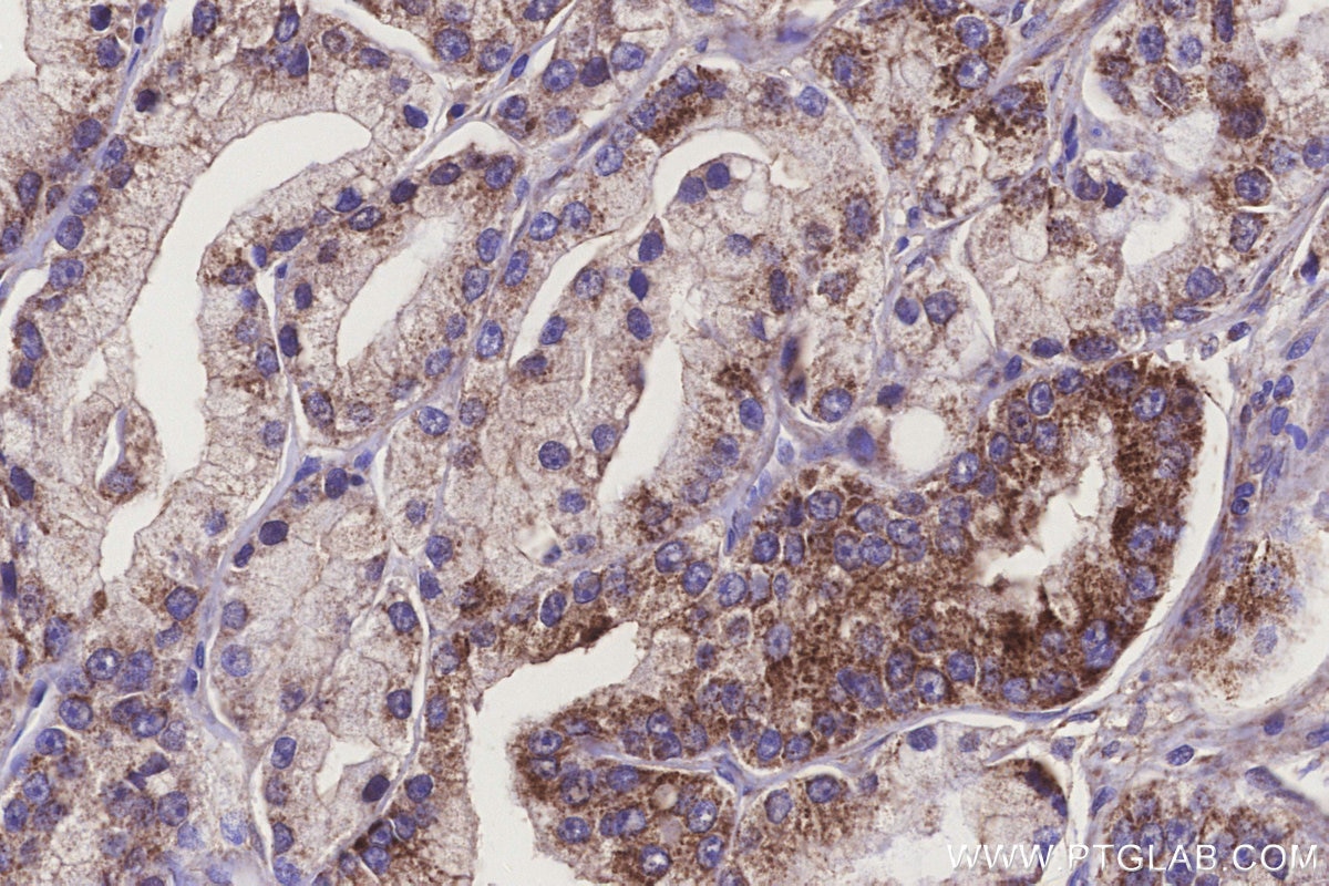 Immunohistochemistry (IHC) staining of human prostate cancer tissue using MOSC1 Polyclonal antibody (25490-1-AP)