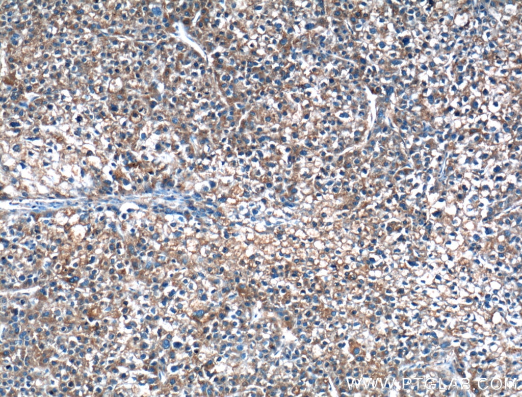 Immunohistochemistry (IHC) staining of human liver cancer tissue using MOSC2 Polyclonal antibody (24782-1-AP)