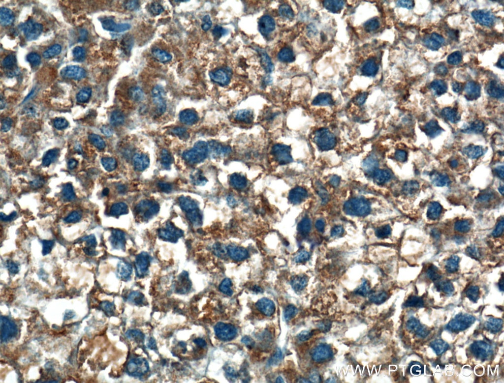 Immunohistochemistry (IHC) staining of human liver cancer tissue using MOSC2 Polyclonal antibody (24782-1-AP)