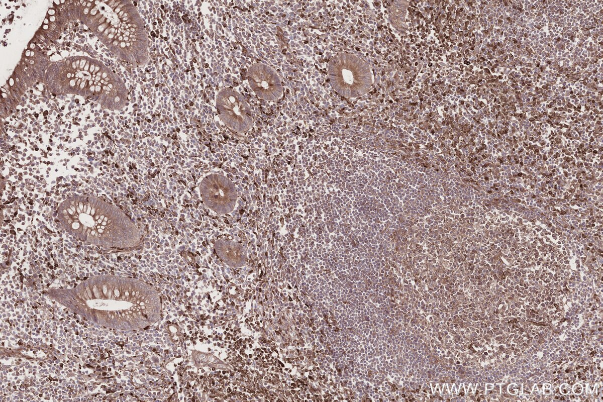 Immunohistochemistry (IHC) staining of human appendicitis tissue using MOSPD2 Recombinant monoclonal antibody (83398-1-RR)