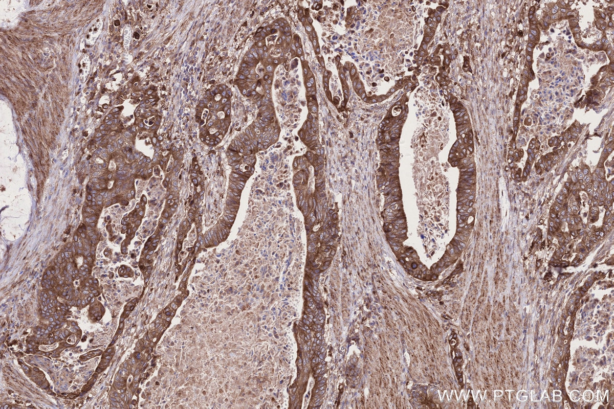 Immunohistochemistry (IHC) staining of human stomach cancer tissue using MOSPD2 Recombinant monoclonal antibody (83398-1-RR)