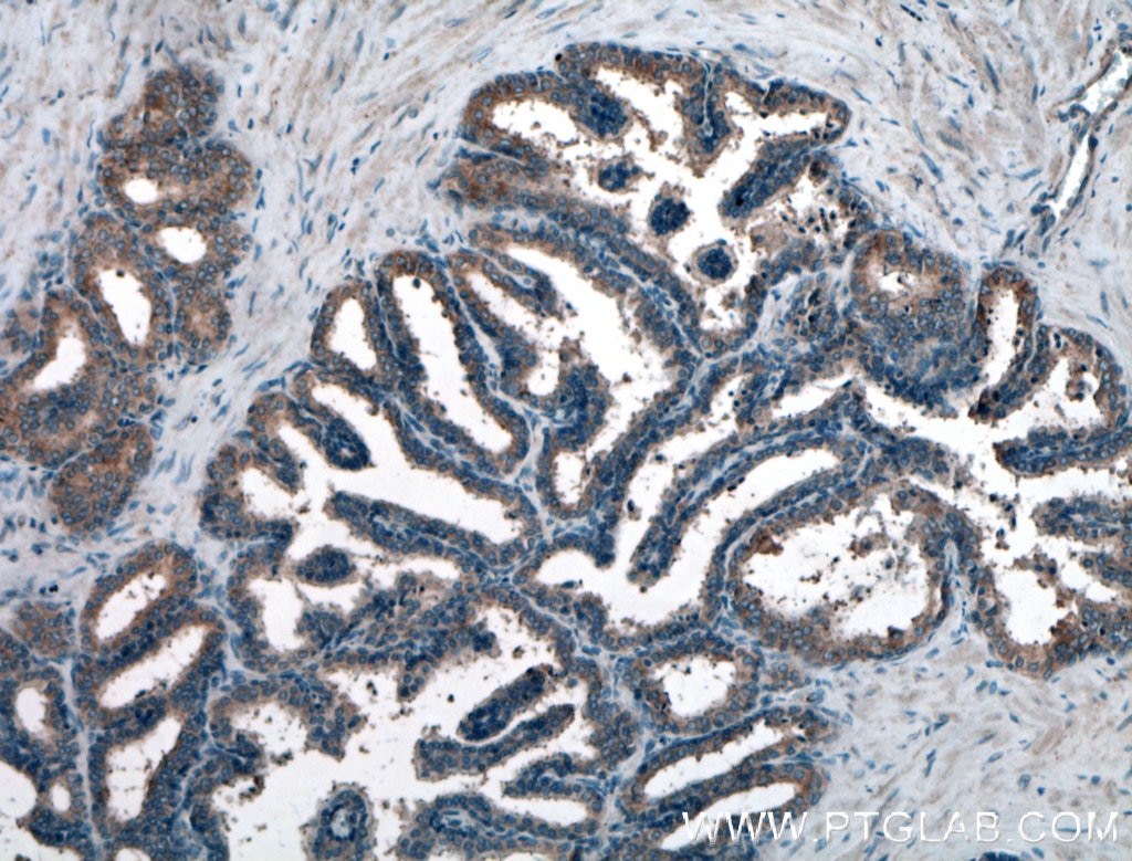 Immunohistochemistry (IHC) staining of human prostate hyperplasia tissue using MOV10 Polyclonal antibody (10370-1-AP)