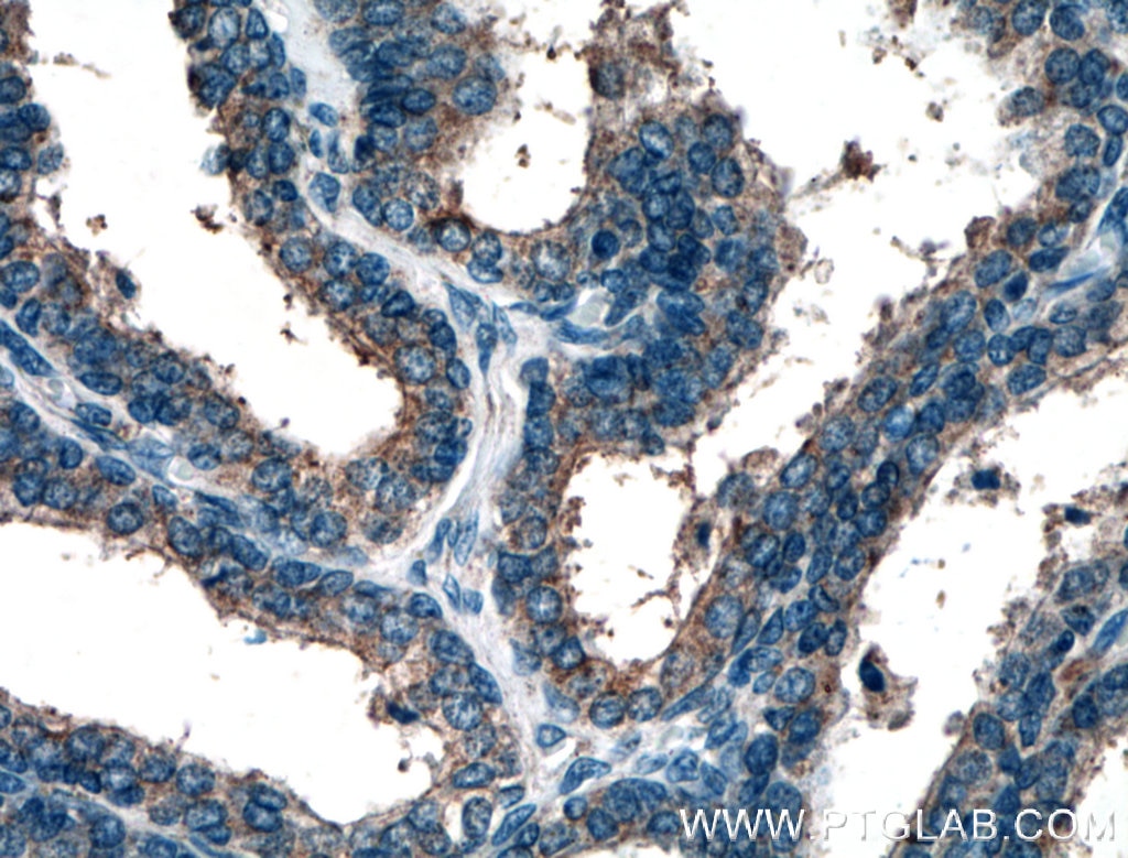 Immunohistochemistry (IHC) staining of human prostate hyperplasia tissue using MOV10 Polyclonal antibody (10370-1-AP)