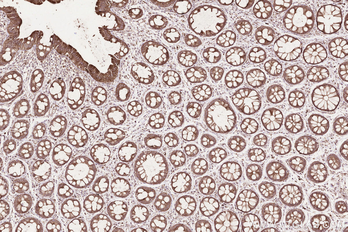 Immunohistochemistry (IHC) staining of human rectal cancer tissue using MPEG1 Polyclonal antibody (23960-1-AP)