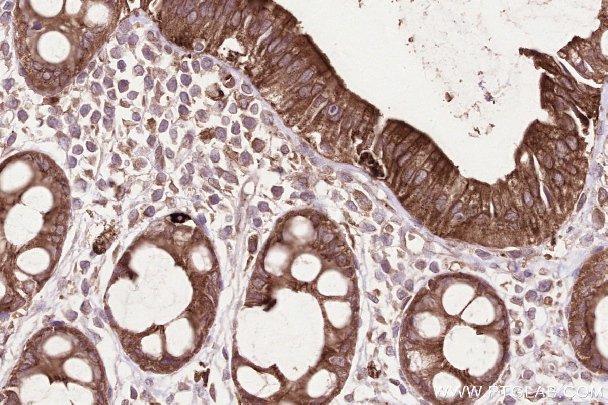 Immunohistochemistry (IHC) staining of human rectal cancer tissue using MPEG1 Polyclonal antibody (23960-1-AP)