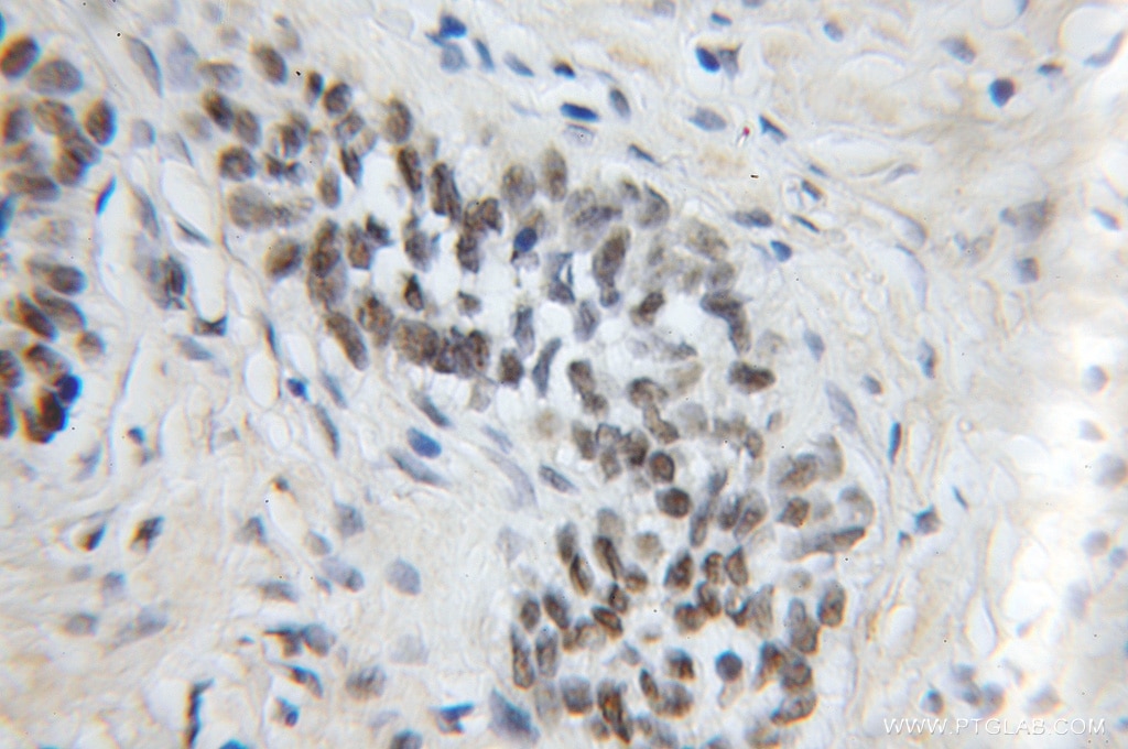 Immunohistochemistry (IHC) staining of human prostate cancer tissue using MPG Polyclonal antibody (11481-2-AP)
