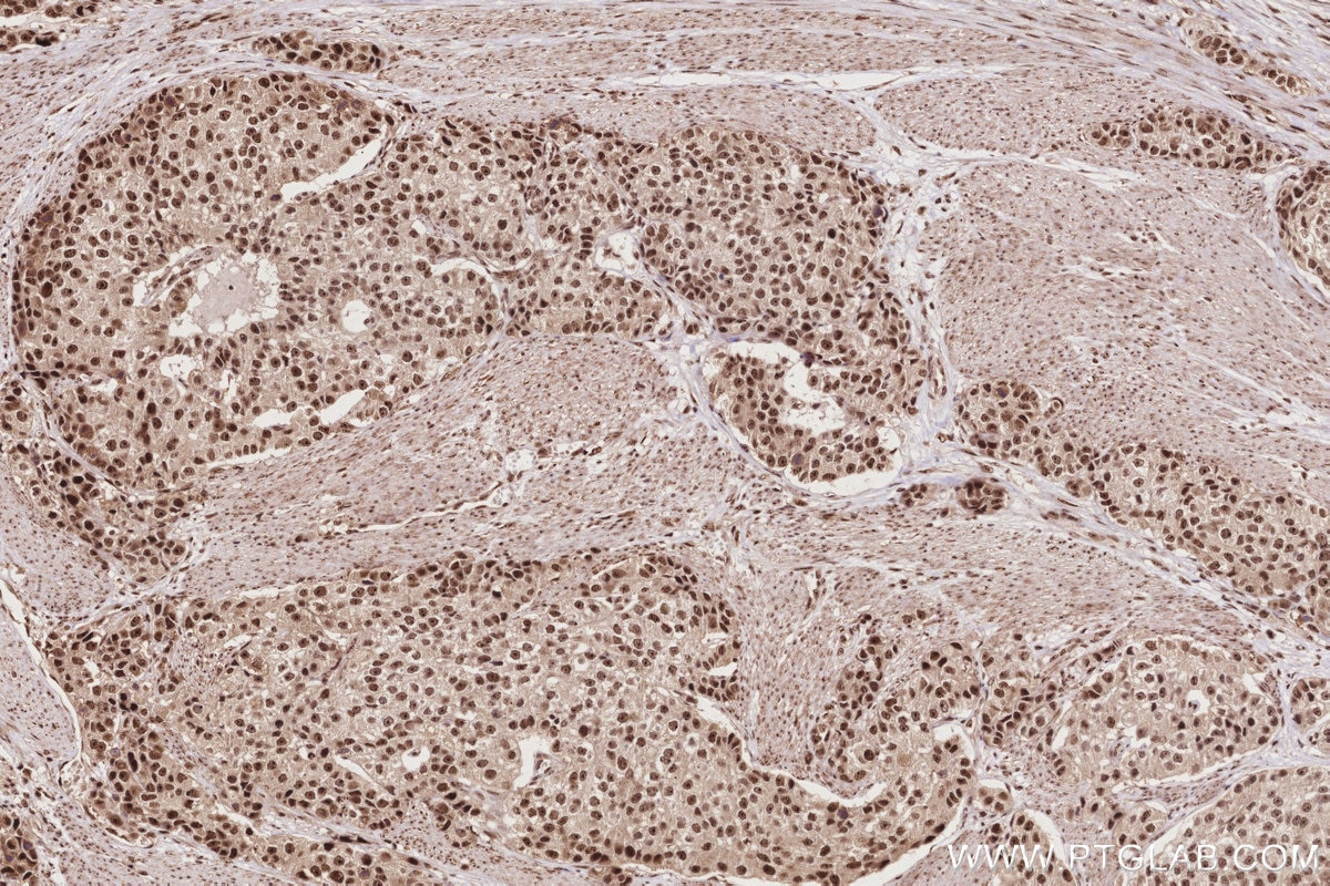 Immunohistochemistry (IHC) staining of human stomach cancer tissue using MPHOSPH6 Polyclonal antibody (10695-1-AP)