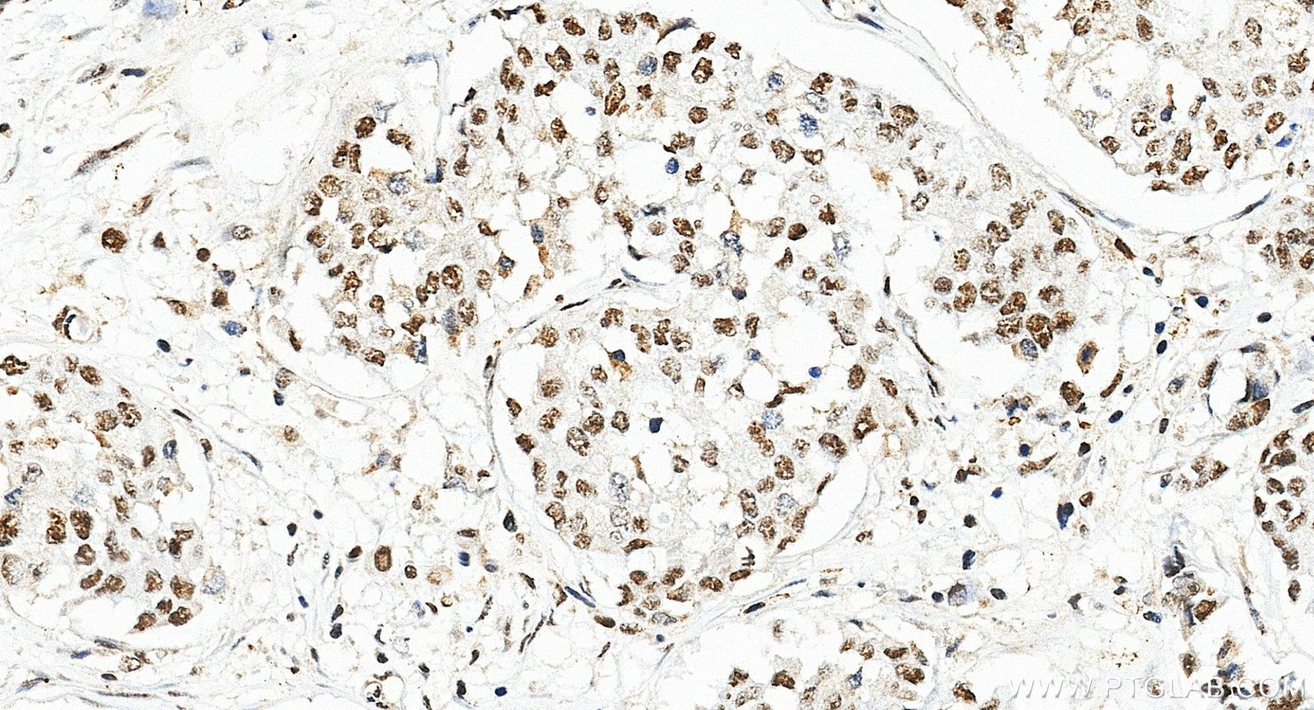 IHC staining of human breast cancer using 10695-1-AP (same clone as 10695-1-PBS) Immunohistochemistry (IHC) staining of human breast cancer tissue using MPHOSPH6 Polyclonal antibody (10695-1-AP)