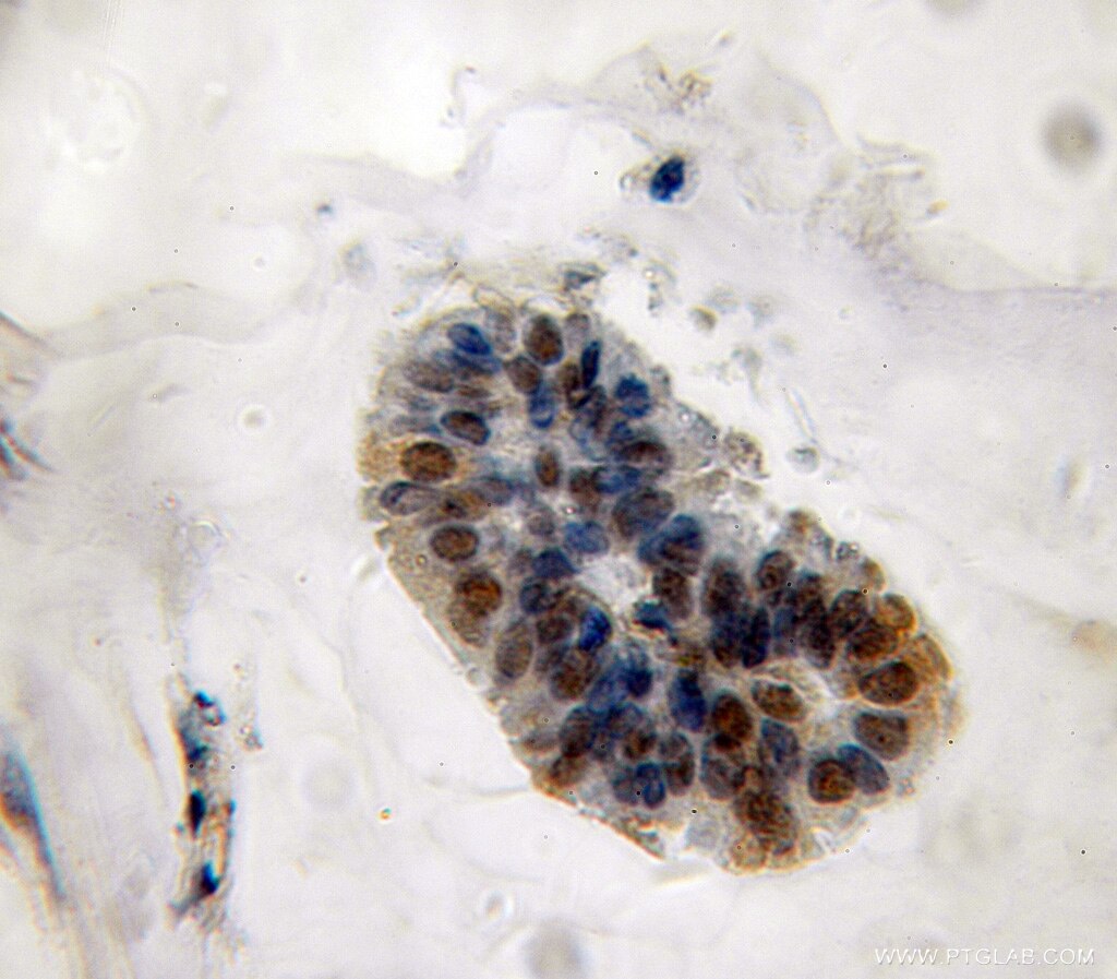 IHC staining of human breast cancer using 10695-1-AP