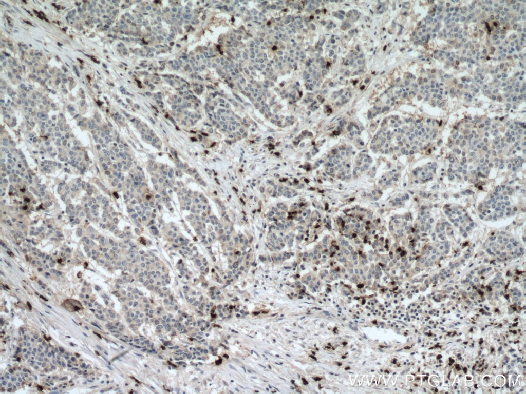 Immunohistochemistry (IHC) staining of human colon cancer tissue using MPO Polyclonal antibody (22225-1-AP)