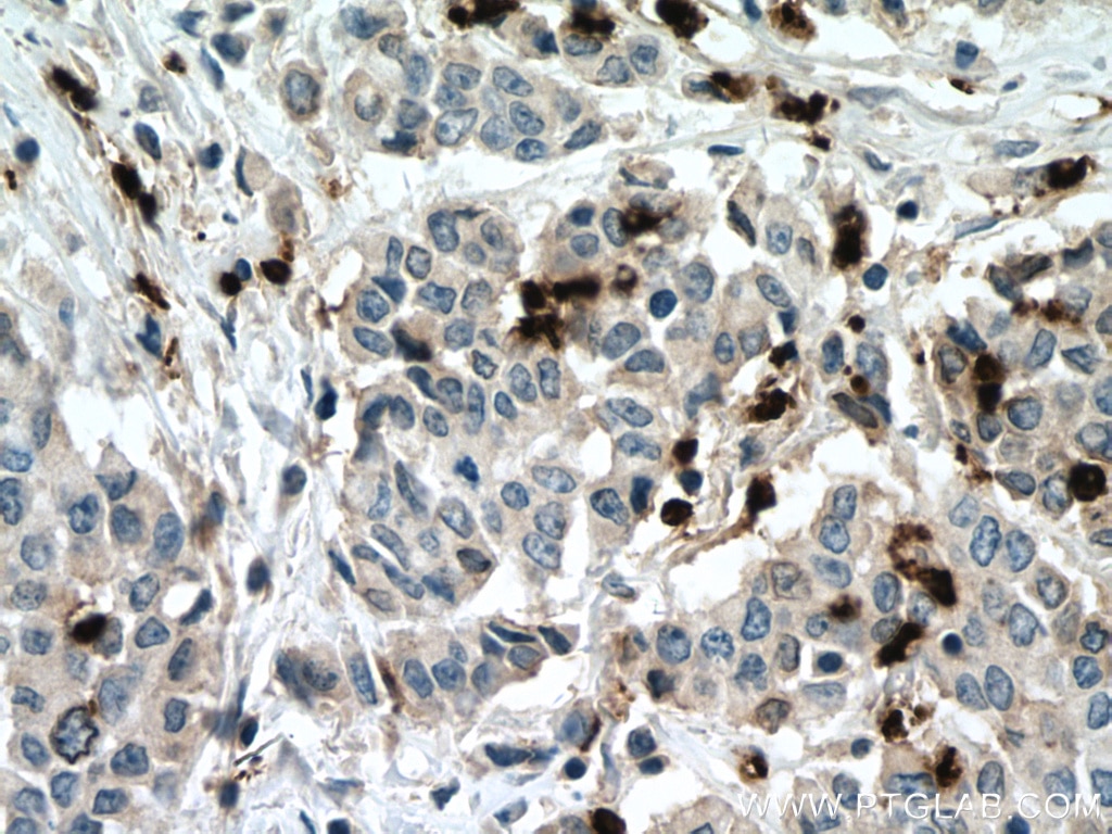 Immunohistochemistry (IHC) staining of human colon cancer tissue using MPO Polyclonal antibody (22225-1-AP)