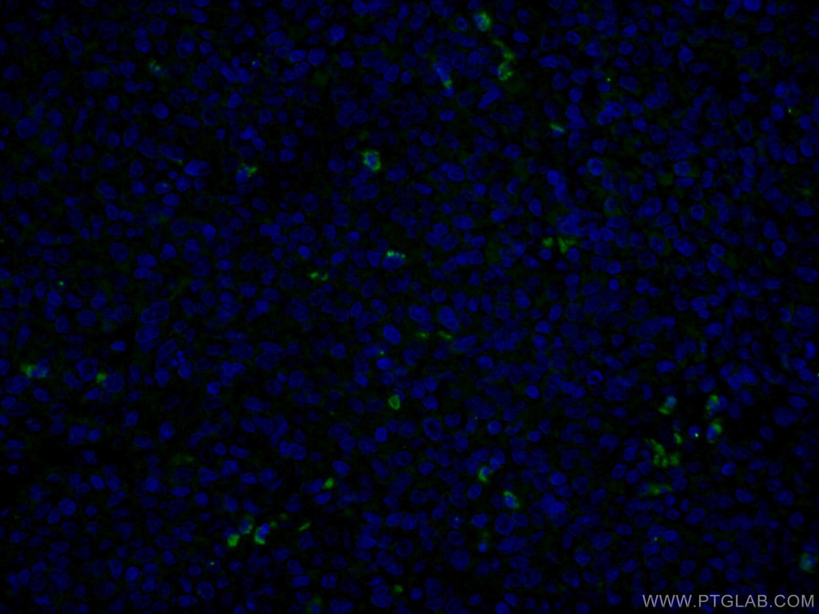 IF Staining of human tonsillitis using 66177-1-Ig