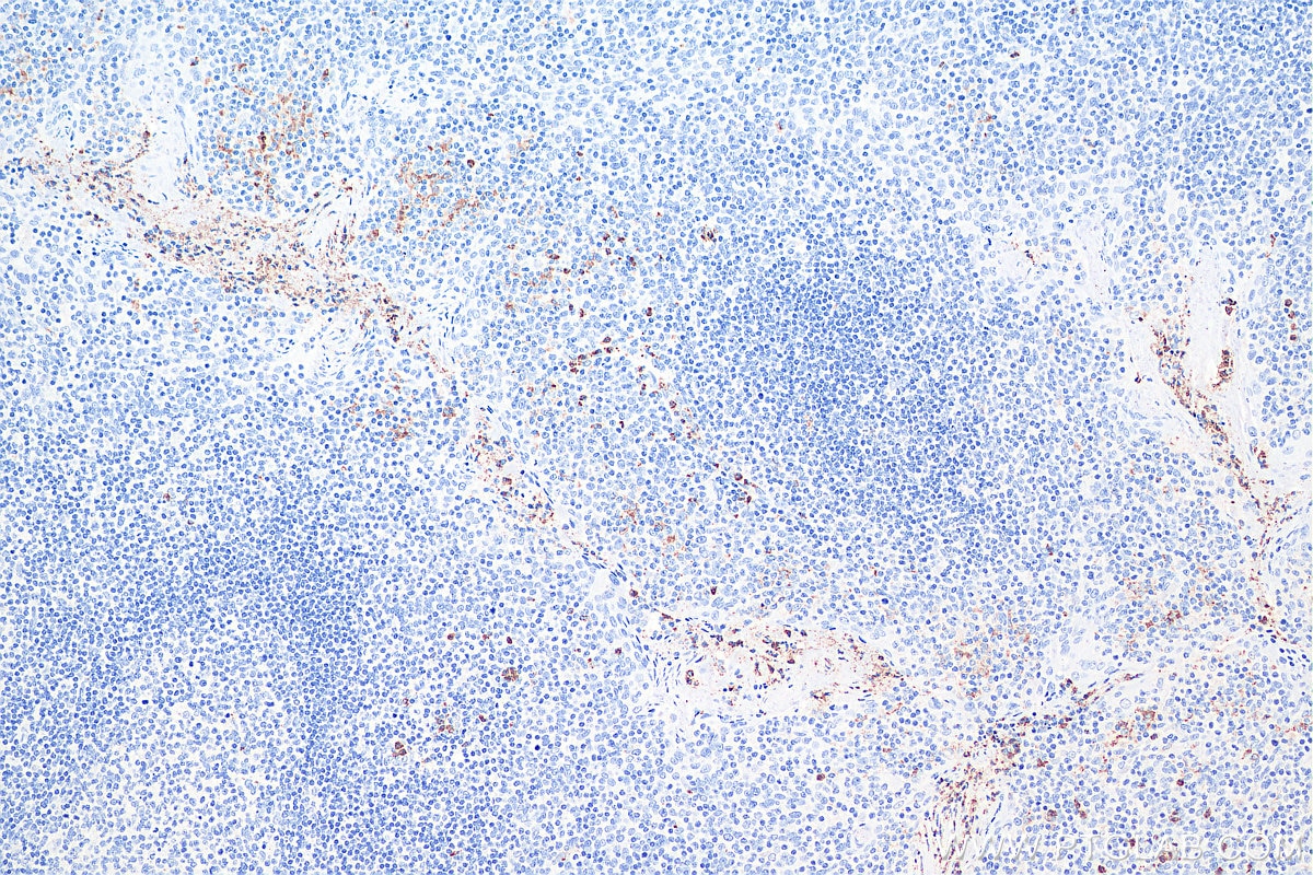 IHC staining of human tonsillitis using 66177-1-Ig