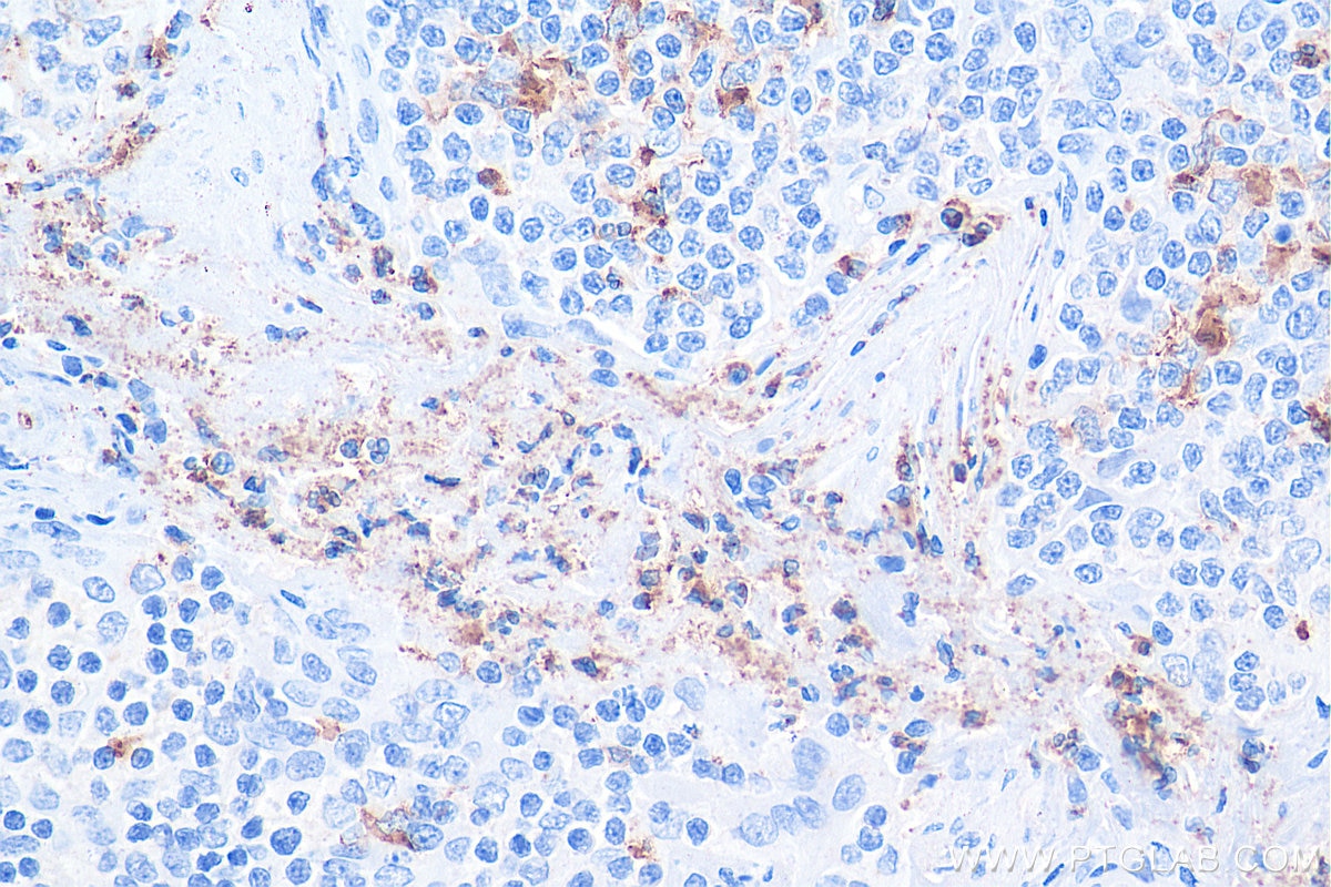 Immunohistochemistry (IHC) staining of human tonsillitis tissue using MPO Monoclonal antibody (66177-1-Ig)