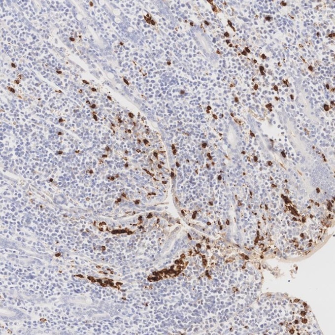 IHC staining of human lymphoma using 81610-1-RR Immunohistochemistry (IHC) staining of human lymphoma tissue using MPO Recombinant monoclonal antibody (81610-1-RR)