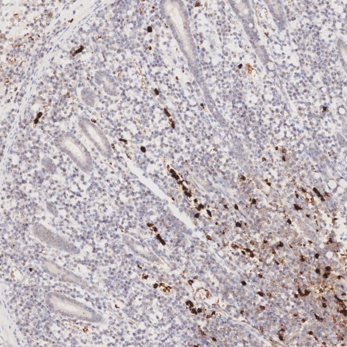 IHC staining of human lymphoma using 81610-1-RR Immunohistochemistry (IHC) staining of human lymphoma tissue using MPO Recombinant monoclonal antibody (81610-1-RR)