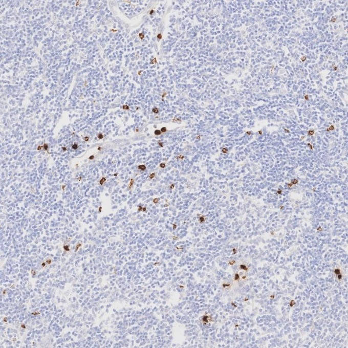 IHC staining of human lymphoma using 81610-1-RR Immunohistochemistry (IHC) staining of human lymphoma tissue using MPO Recombinant monoclonal antibody (81610-1-RR)