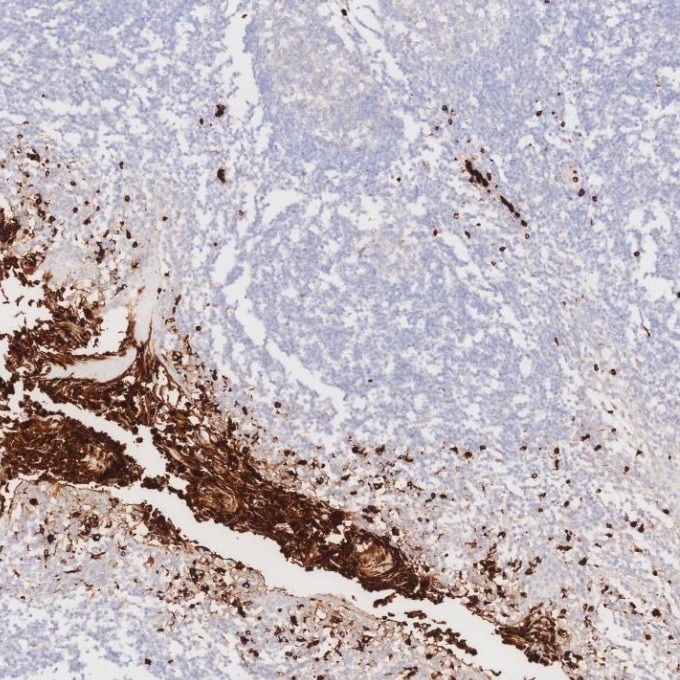 IHC staining of human tonsillitis using 81610-1-RR Immunohistochemistry (IHC) staining of human tonsillitis tissue using MPO Recombinant monoclonal antibody (81610-1-RR)