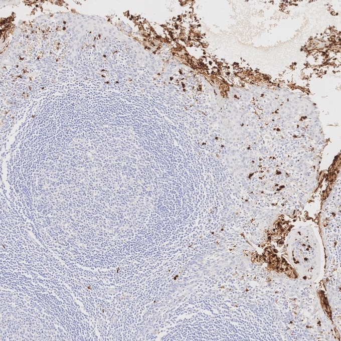IHC staining of human tonsillitis using 81610-1-RR Immunohistochemistry (IHC) staining of human tonsillitis tissue using MPO Recombinant monoclonal antibody (81610-1-RR)