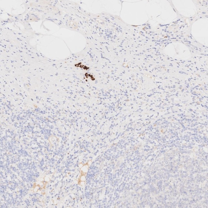 IHC staining of human appendicitis using 81610-1-RR Immunohistochemistry (IHC) staining of human appendicitis tissue using MPO Recombinant monoclonal antibody (81610-1-RR)